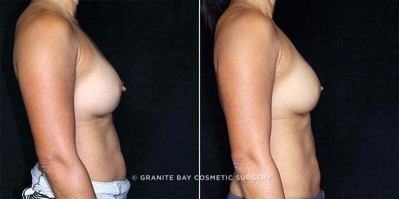 revision-breast-implant-exchange-19975c-clark