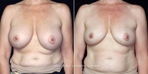 Breast Removal