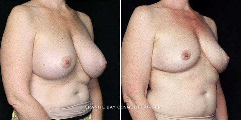 revision-breast-implant-removal-11806b-clark