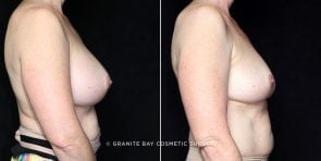 revision-breast-implant-removal-11806c-clark