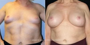 breast-augmentation-18121a-clark-watermarked