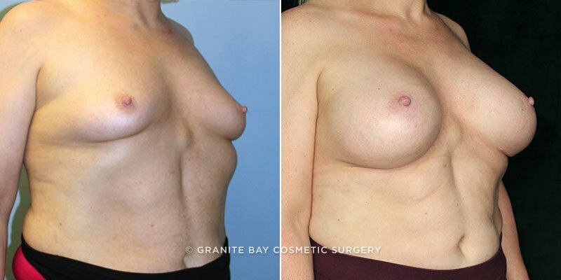 breast-augmentation-18121b-clark-watermarked