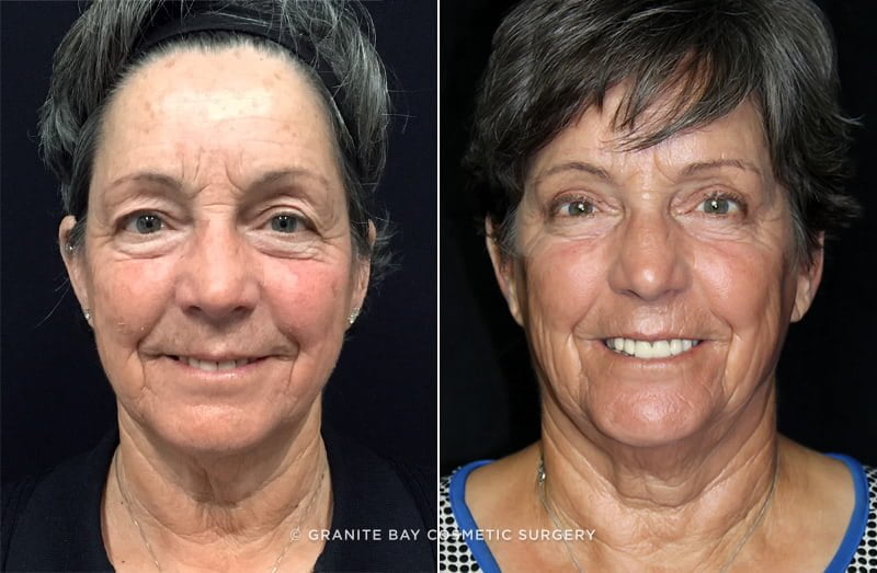 Blepharoplasty & Microneedling