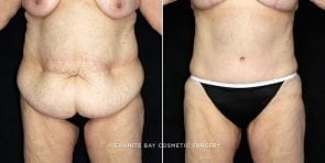 abdominoplasty-liposuction-19716a-clark