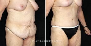 abdominoplasty-liposuction-19716b-clark