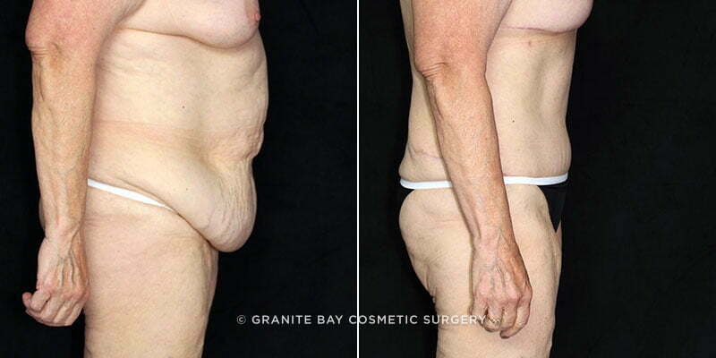 abdominoplasty-liposuction-19716c-clark