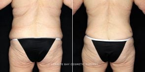 abdominoplasty-liposuction-19716d-clark