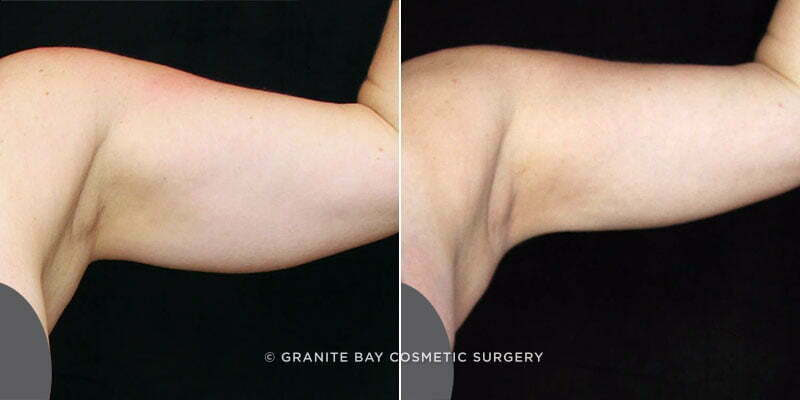 arm-liposuction-20118a-left-clark