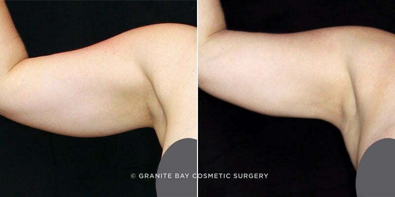 Arm Liposuction