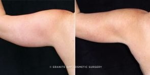 arm-liposuction-20118d-left-clark