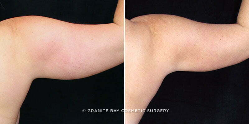 arm-liposuction-20118d-right-clark