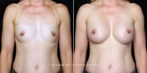 breast-augmentation-17862a-clark