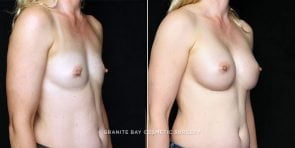 breast-augmentation-17862b-clark