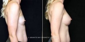 breast-augmentation-17862c-clark