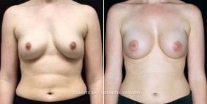 breast-augmentation-19520a-clark