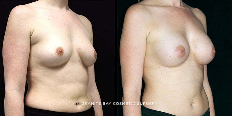 breast-augmentation-19520b-clark