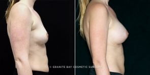 breast-augmentation-19520c-clark