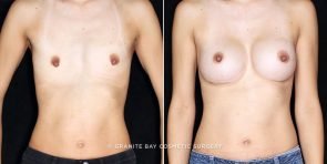 breast-augmentation-19651a-clark