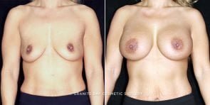 breast-augmentation-19709a-clark