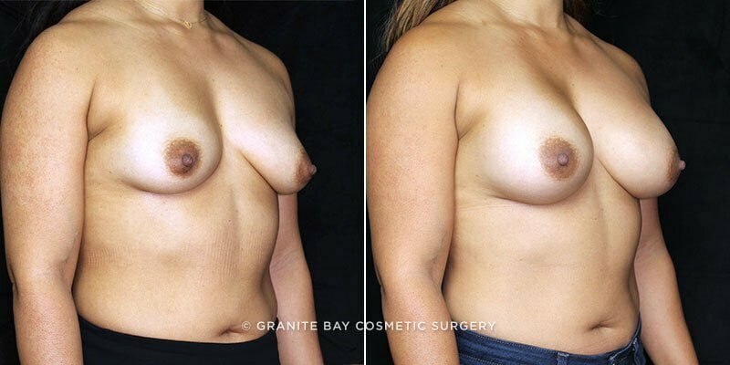 breast-augmentation-19752b-clark