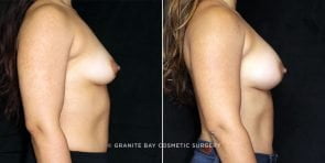 breast-augmentation-19752c-clark