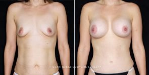 breast-augmentation-19870a-clark
