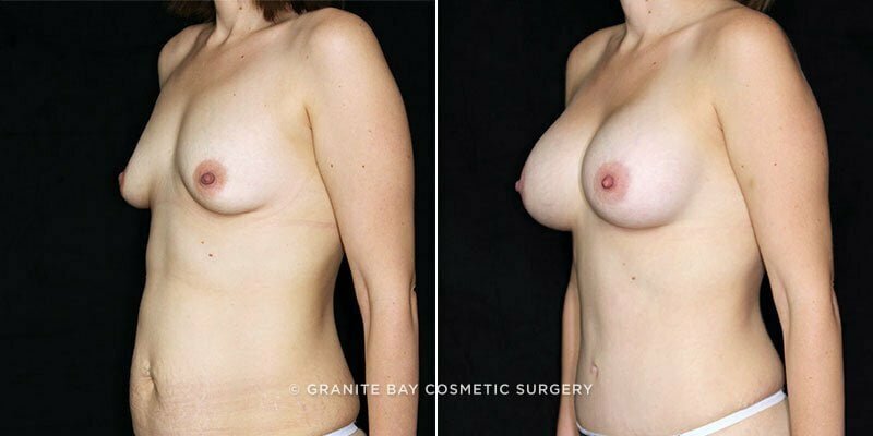breast-augmentation-19870b-clark