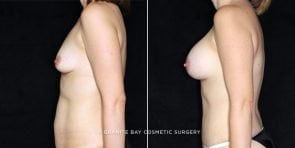 breast-augmentation-19870c-clark