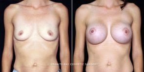 breast-augmentation-20235a-clark