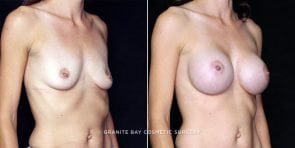 breast-augmentation-20235b-clark