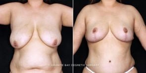 breast-lift-abdominoplasty-20036a-clark