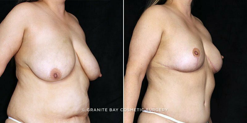 breast-lift-abdominoplasty-20036b-clark