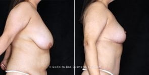 breast-lift-abdominoplasty-20036c-clark