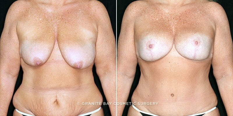 breast-lift-with-augmentation-19591a-clark
