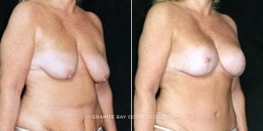 breast-lift-with-augmentation-19591b-clark