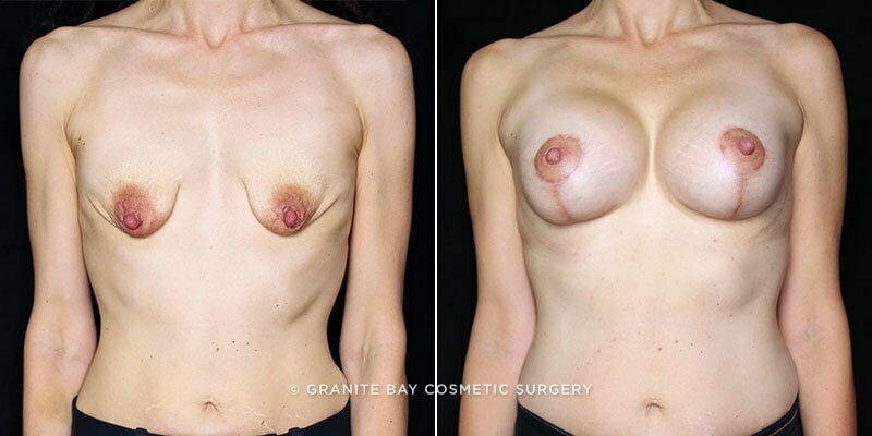 breast-lift-with-augmentation-19843a-clark