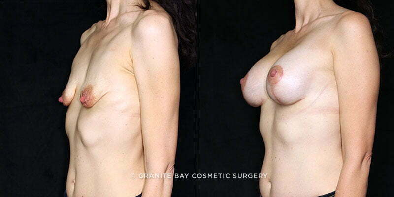 breast-lift-with-augmentation-19843b-clark