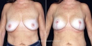 breast-lift-with-augmentation-19863a-clark