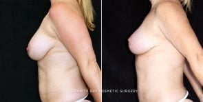 breast-reduction-20118c-clark