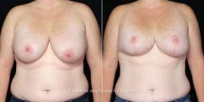breast-reduction-liposuction-19723a-clark