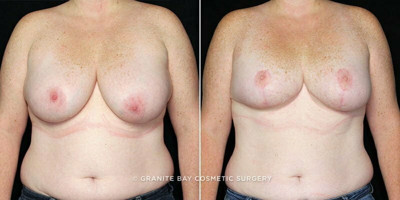 Breast Reduction