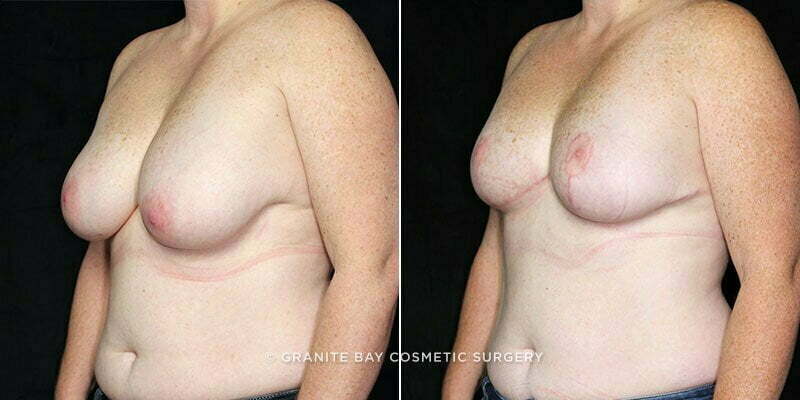 breast-reduction-liposuction-19723b-clark