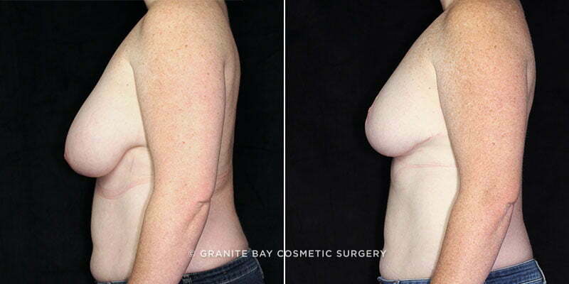 breast-reduction-liposuction-19723c-clark