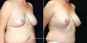 breast-revision-abdomin-lipo-18496b-clark