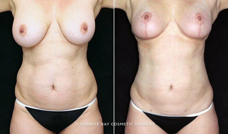 liposuction-abdominal-flanks-20118a-clark