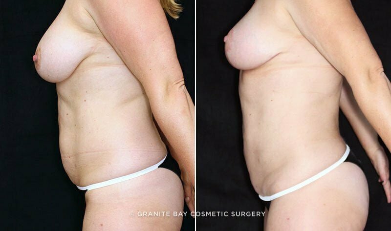 liposuction-abdominal-flanks-20118c-clark