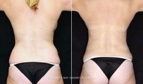Liposuction Abdominal & Flanks