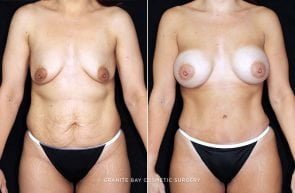 mmo-abdominoplasty-breast-aug-19775a-clark