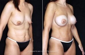 mmo-abdominoplasty-breast-aug-19775b-clark