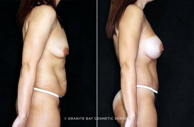 mmo-abdominoplasty-breast-aug-19775c-clark
